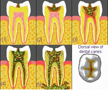Dentindent - Diş çürükleri