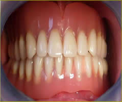 Dentindent - Hareketli Protezler