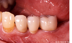 Dentindent - İmplant Uygulamaları