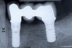 Dentindent - İmplant Uygulamaları